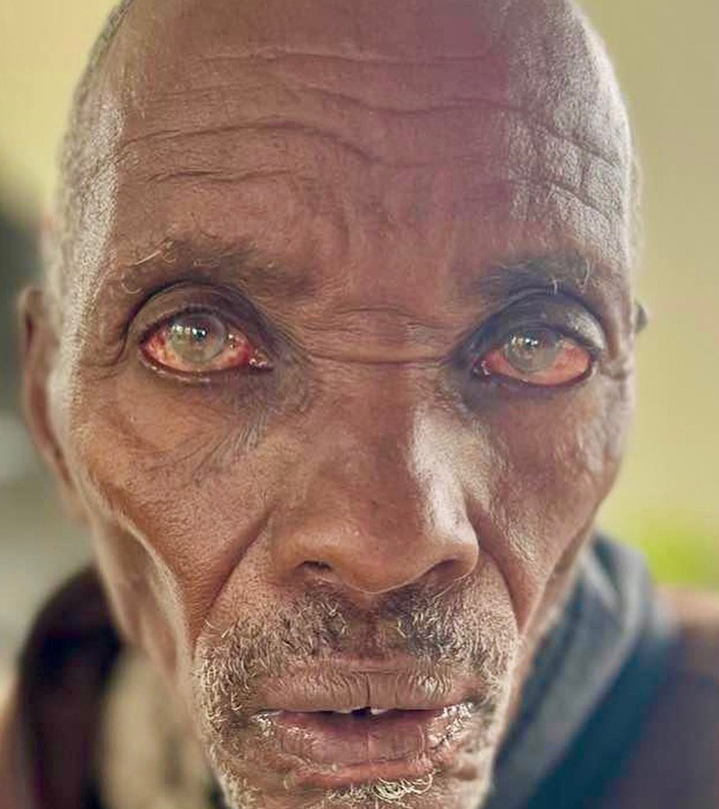 Close-up of a man in Tanzania before receiving vision correction, showing severe eye condition.